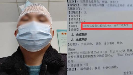 男子打球6天后頭皮里發現2顆牙，網友神評論