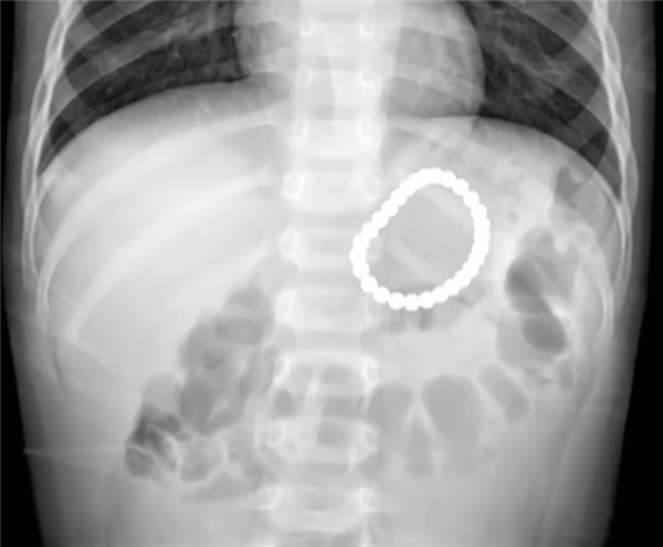 太危險了！2歲幼童誤吞28顆磁力珠，網紅玩具惹的禍！