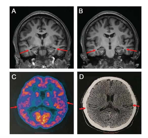 醫生發現19歲阿爾茲海默癥患者 現今為止已知最年輕患者