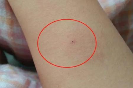 正常人的結核皮試圖