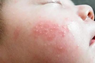 <a href=/e/tags/?tagname=新生兒 target=_blank class=infotextkey>新生兒</a>起濕疹什么原因？