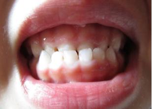 小寶寶反頜可以用手按嗎？寶寶反頜怎么矯正呢？