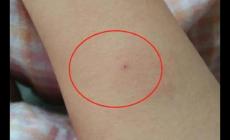 正常的結核皮試是什么樣的？正常人的結核皮試圖