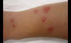 被蟑螂咬后會怎么樣？蟑螂咬人后的皮膚圖片