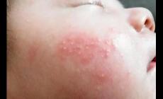 新生兒起濕疹什么原因？新生兒濕疹 面部圖片