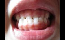 小寶寶反頜可以用手按嗎？寶寶反頜怎么矯正呢？