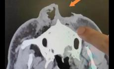 驚險!男子上山采菌被熊咬掉一半鼻子,怎么回事?