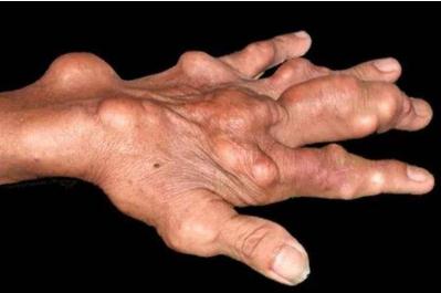 尿酸高有哪些癥狀