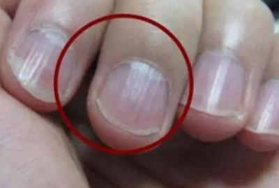 指甲有豎紋是身體的什么信號(hào)啊