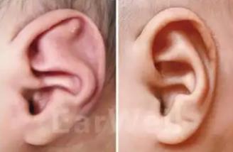 <a href=/e/tags/?tagname=新生兒 target=_blank class=infotextkey>新生兒</a>外耳廓粘連如何矯正