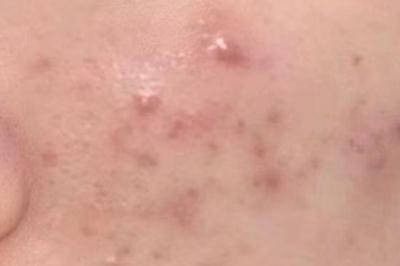 痘痘變成硬硬的鼓包圖片
