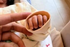 嬰兒出生第四天黃疸19 出生第四天黃疸19嚴重嗎