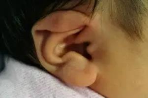 <a href=/e/tags/?tagname=新生兒 target=_blank class=infotextkey>新生兒</a>耳朵粘連需要矯正嗎