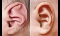 新生兒外耳廓粘連如何矯正
