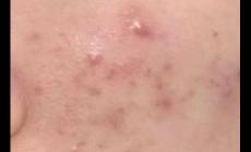 痘痘變成硬硬的鼓包怎么去除 痘痘變成硬硬的鼓包圖片