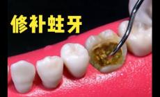 “10歲娃用牙洞修復牙膏后損失6顆牙”火的原因醫生說出了真相