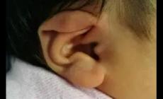 新生兒耳朵粘連需要矯正嗎