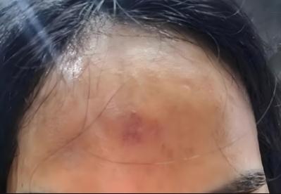 印堂發紅是什么的征兆 印堂發紅預示著出現哪些健康問題