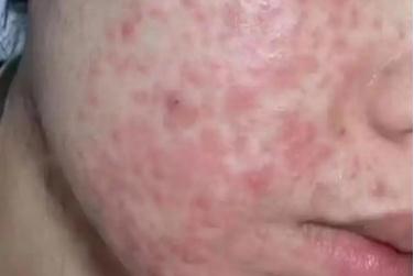 凍干粉會引起激素臉嗎 凍干粉會造成激素臉嗎