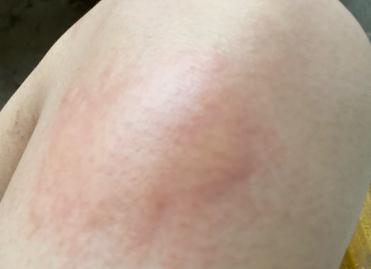 打破傷風后一周出現紅腫發癢怎么回事啊