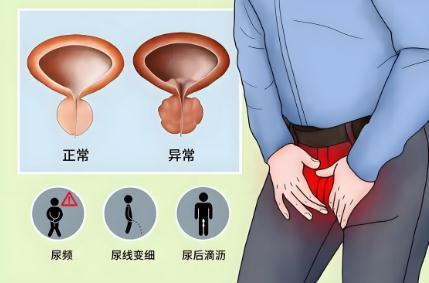 前列腺增生是怎么回事 前列腺增生是什么意思