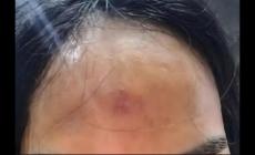 印堂發紅是什么的征兆 印堂發紅預示著出現哪些健康問題