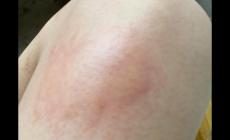 打破傷風(fēng)后一周出現(xiàn)紅腫發(fā)癢怎么回事啊?