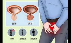 前列腺增生是怎么回事 前列腺增生是什么意思