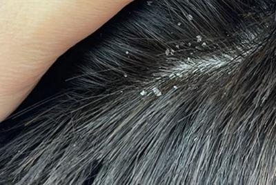 頭皮屑太多怎么洗才能除根 快速去除頭皮屑小妙招