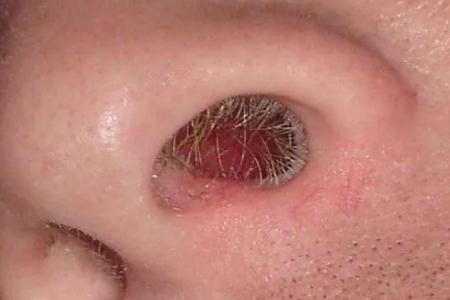 鼻毛變白是怎么回事 鼻毛白了是什么原因引起的