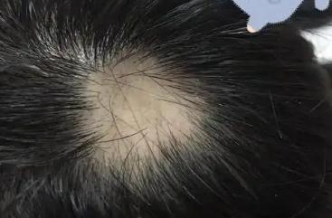 頭發禿了一塊是什么原因造成的