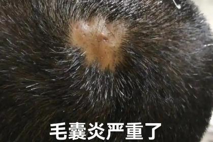 頭皮毛囊炎掛哪個科室的號 頭皮毛囊炎掛什么科室的號好