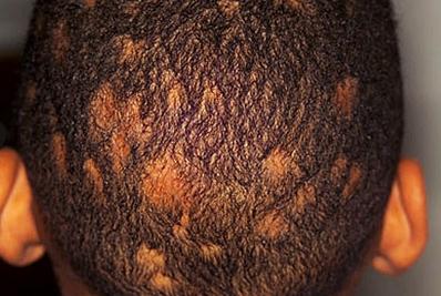 頭癬區域性脫發怎么辦啊 頭癬區域性脫發怎么辦啊圖片