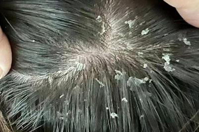 頭上有大塊頭皮屑怎么回事 頭上有大塊頭皮屑怎么去掉