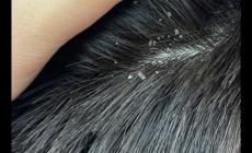 頭皮屑太多怎么洗才能除根 快速去除頭皮屑小妙招