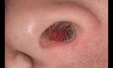 鼻毛變白是怎么回事 鼻毛白了是什么原因引起的