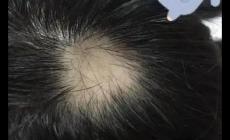 頭發禿了一塊是什么原因造成的