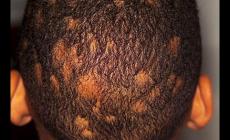 頭癬區域性脫發怎么辦啊 頭癬區域性脫發怎么辦啊圖片