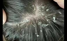 頭上有大塊頭皮屑怎么回事 頭上有大塊頭皮屑怎么去掉