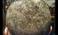 頭皮癬跟頭皮屑有區別嗎 頭皮屑和頭皮癬的區別是什么