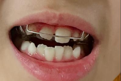 兒童矯正牙齒可以報銷嗎 兒童矯正牙齒可以用醫保卡嗎