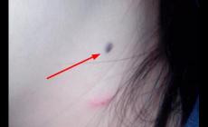 醫院祛痣掛什么科室 醫院祛痣掛什么科室的號